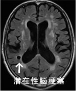 MRI画像1