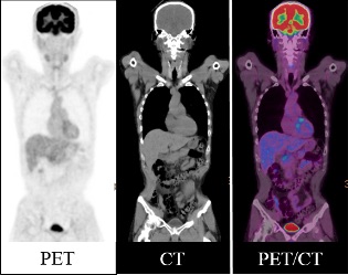 当院で撮像されたPET/CT画像（正常例）